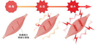 筋肉痛について